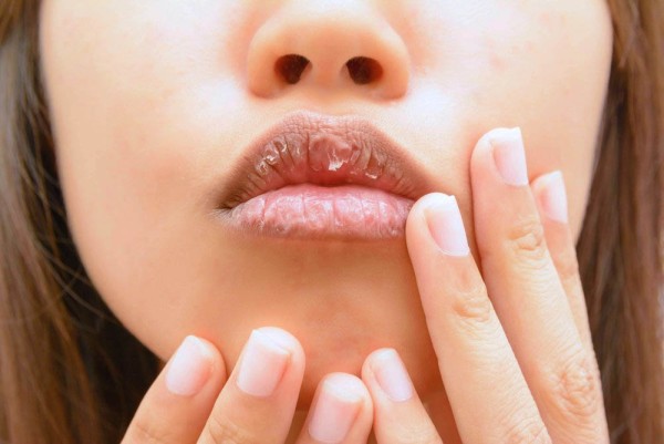Основні причини, через які тріскаються губи, і як позбутися цієї проблеми – 2