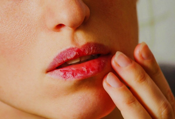 Основні причини, через які тріскаються губи, і як позбутися цієї проблеми – 3