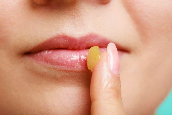 Основні причини, через які тріскаються губи, і як позбутися цієї проблеми – 4