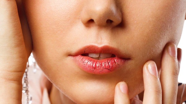 Основні причини, через які тріскаються губи, і як позбутися цієї проблеми